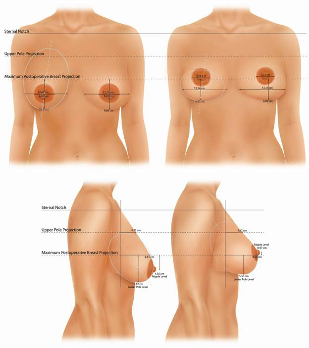 Breast Lift Without Implants After Weight Loss